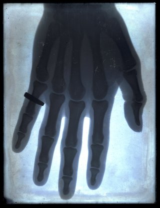 **Frank Styant Browne** *Hand* 1896, X-ray, Queen Victoria Museum and Art Gallery collection, Launceston 